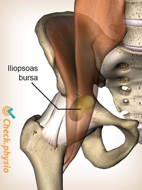 hip iliopsoas bursa bursitis