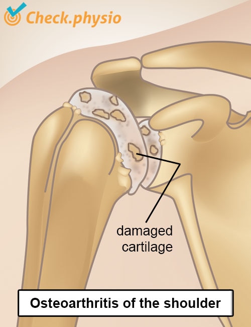 shoulder arteriosclerosis