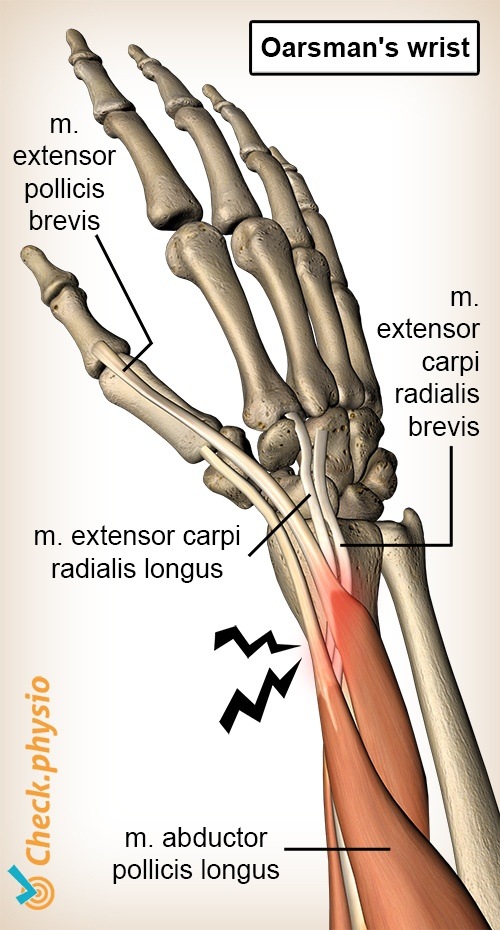 arm oarsmens wrist anatomy extensor carpi radialis brevis longus abductor pollicis