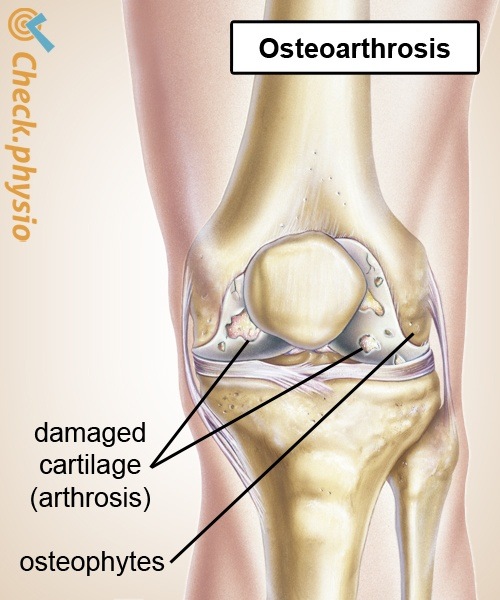 knee osteoarthritis degeneration cartilage