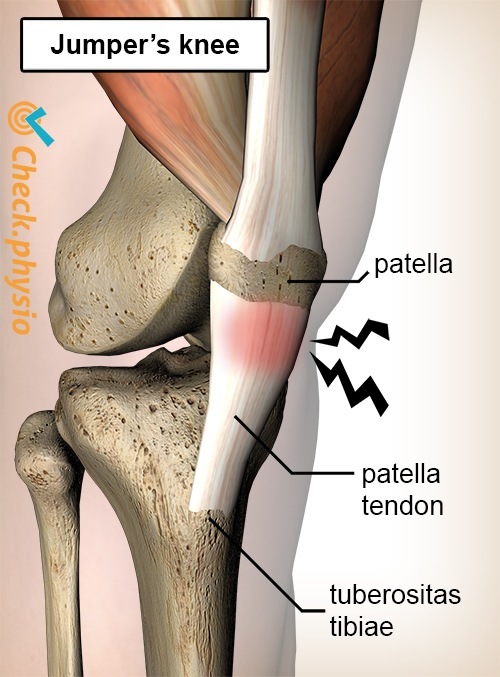 knee jumpers knee pain patella tendon tendinitis