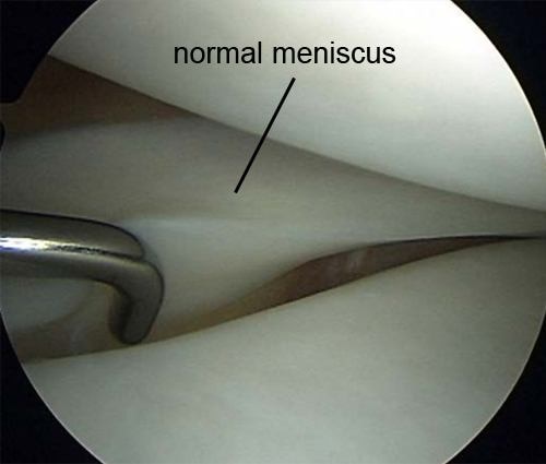 knee meniscus degeneration healthy