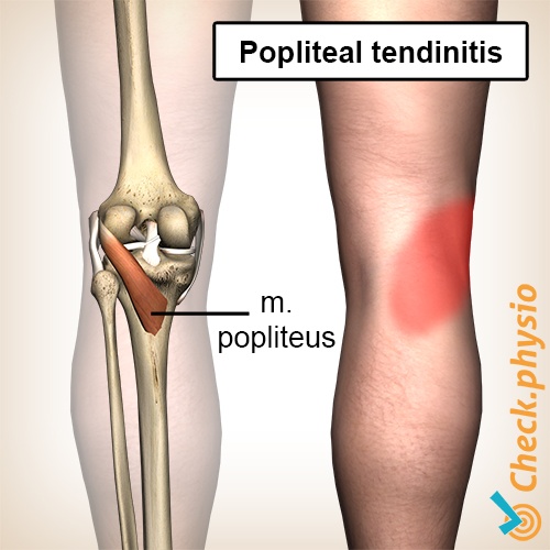 knee popliteus tendinitis