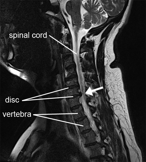 neck cervical radiculopathy soft hernia