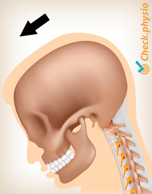 neck whiplash pain movement 2