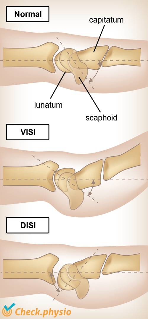 wrist VISI DISI