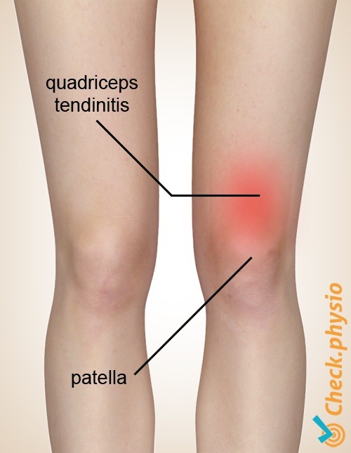 quadriceps tendinitis