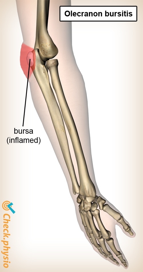 arm olecranon bursitis anatomy