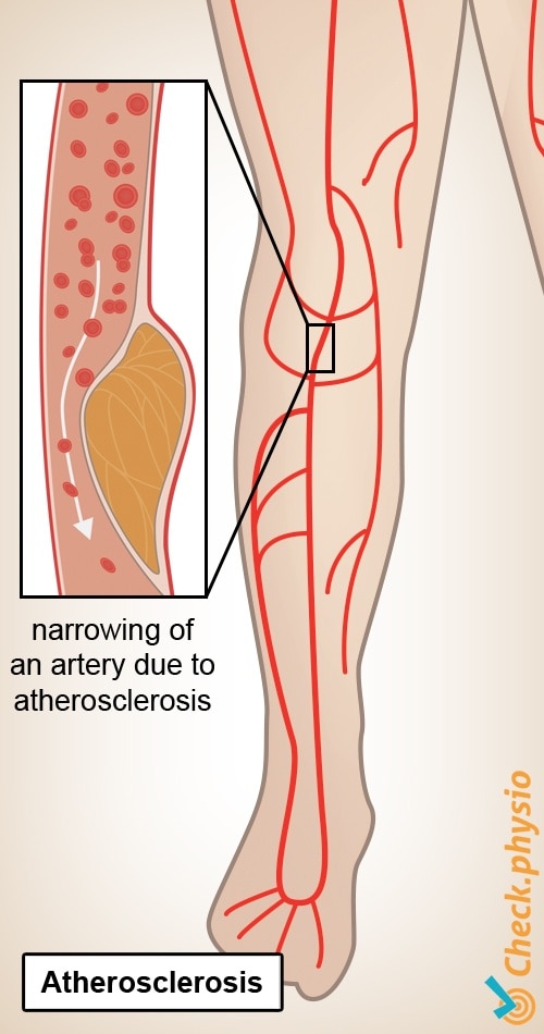 leg shop window legs intermittent claudication plaque formation