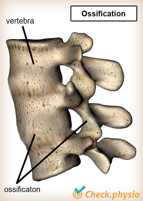 back Bechterew vertebrae ossification