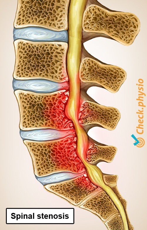 back spinal canal stenosis anatomy cross section