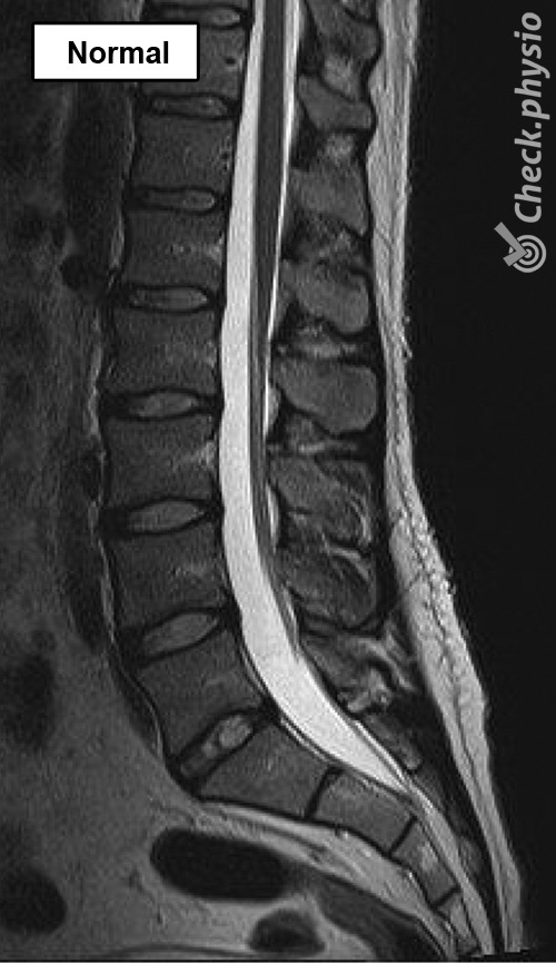 back lumbar spine mri normal