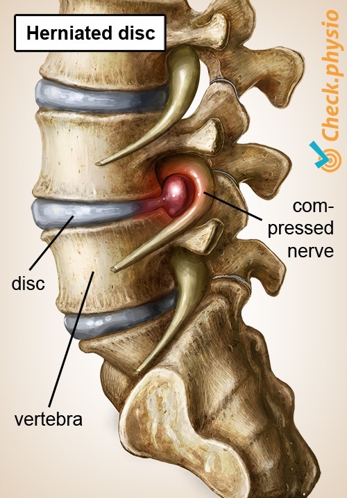back specific low back pain disc hernia