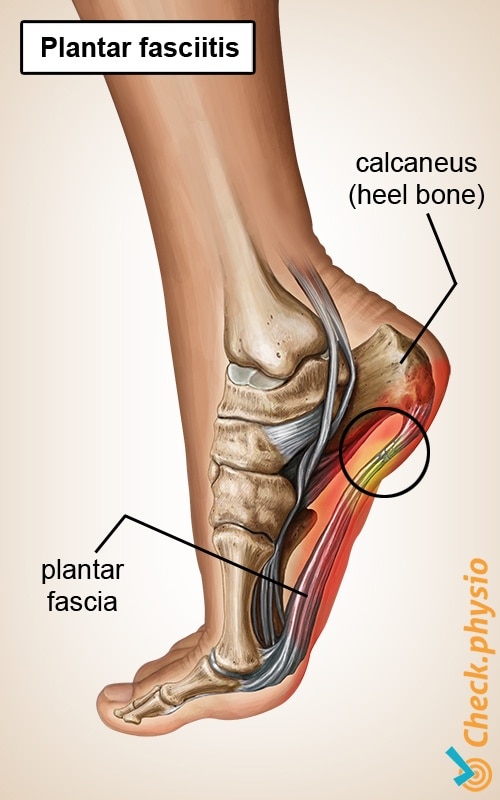 foot plantar fasciitis aponeurosis heel spur