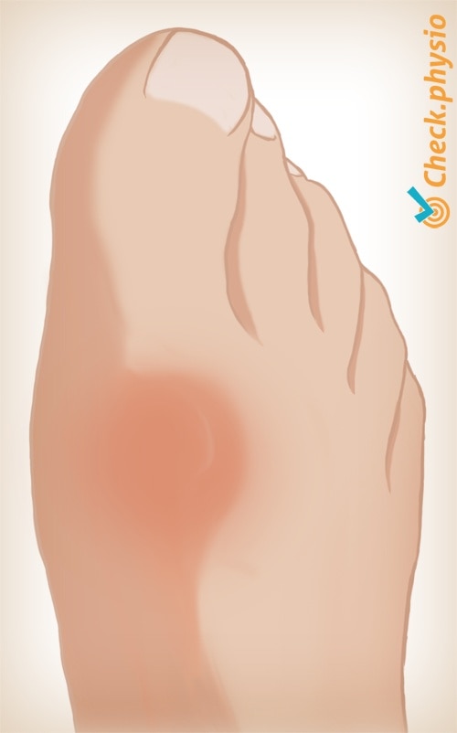 foot hallux rigidus picture