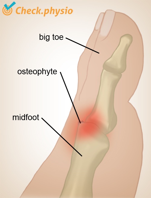 foot hallux rigidus osteophyte formation