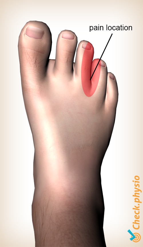 foot Mortons neuroma pain location