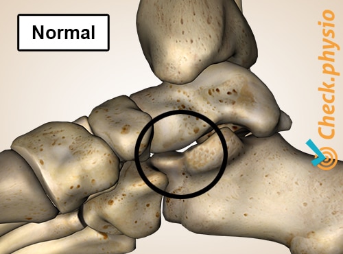 foot tarsal talocalcaneal coalition normal