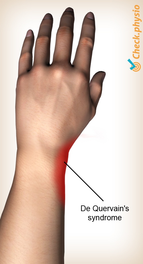 arm quervains disease location
