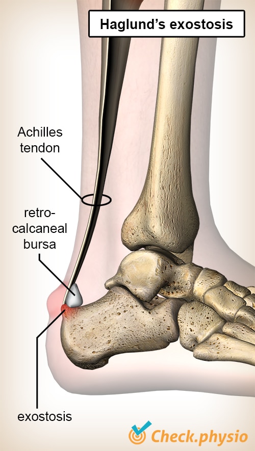 ankle Haglund exostosis deformity achilles tendon retrocalcaneal bursa heel bone calcaneus