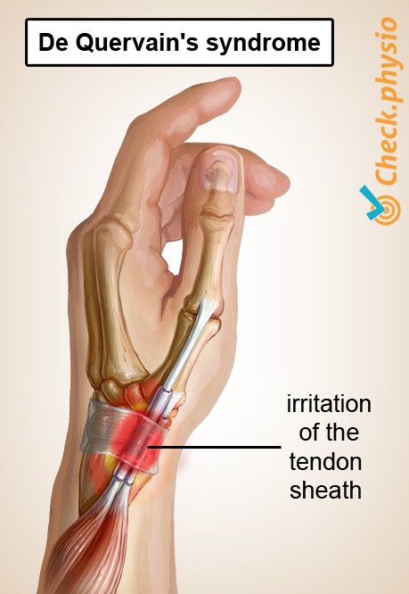 arm quervains disease
