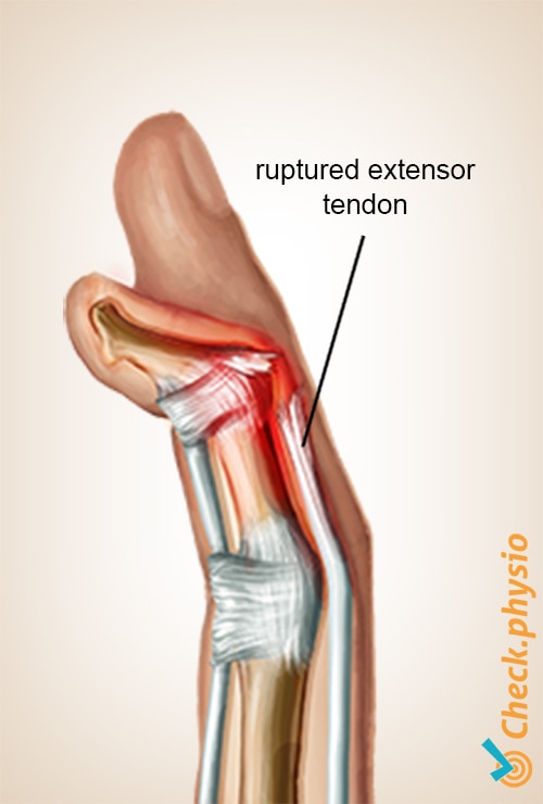 hand mallet finger anatomy