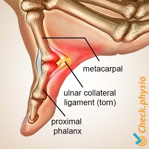 hand skiers thumb anatomy collateral ulnar ligament