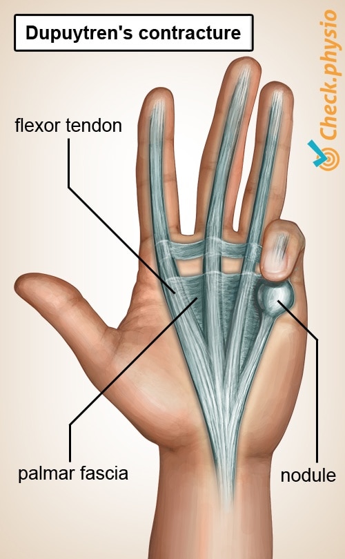 hand Dupuytrens disease palmaris nodule