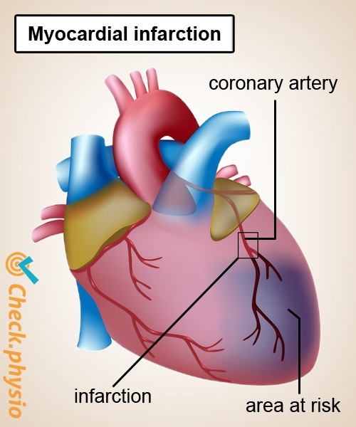 heart attack coronary artery anatomy