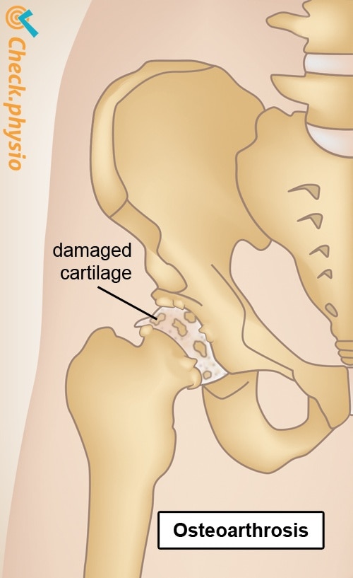 hip osteoarthritis