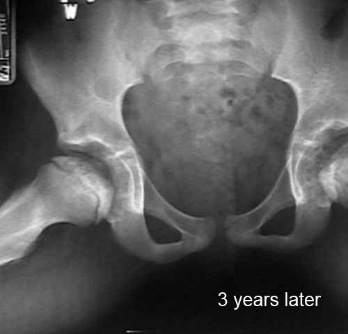 hip calve legg perthes age 9