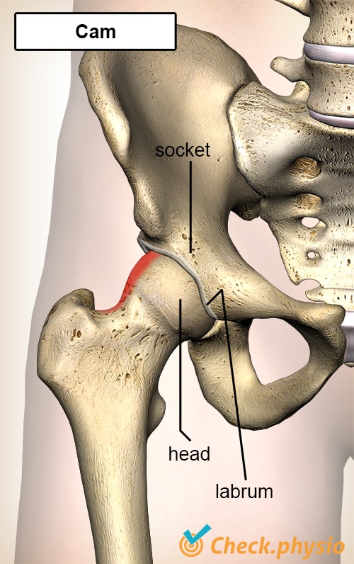 hip femoroacetabular impingement FAI cam