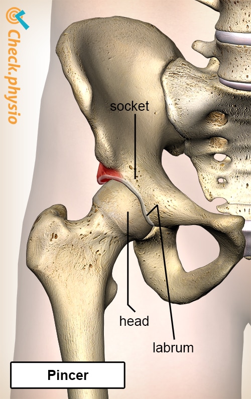 hip femoroacetabular impingement FAI pincer