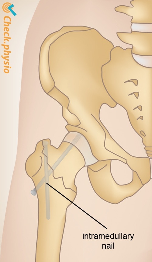 hip fracture gamma nail