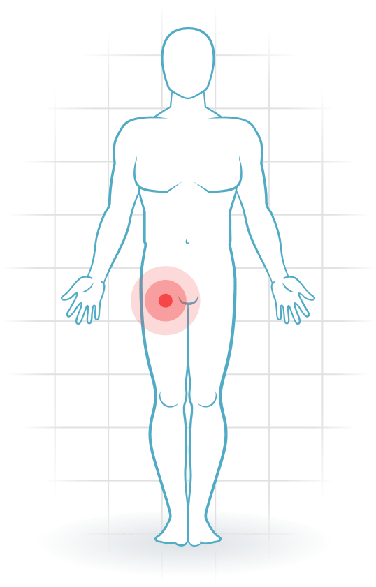 pijnlocatie Hip impingement