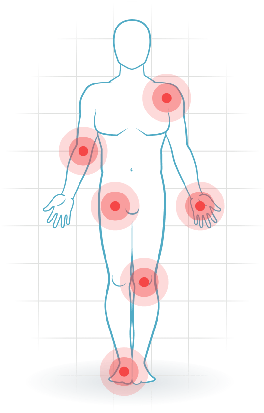 pijnlocatie Fibromyalgia