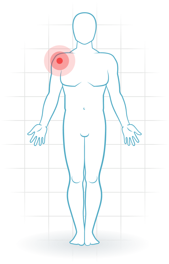 pijnlocatie Internal impingement