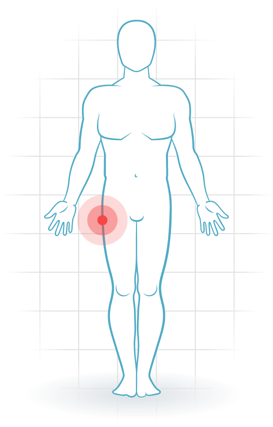 pijnlocatie Greater trochanter pain syndrome