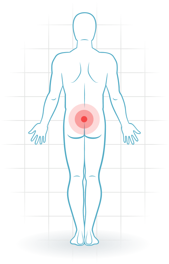 pijnlocatie SI joint pain