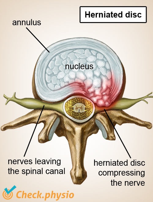 afbeelding_alt_wervelkolom-wervel-tussenwervelschijf-hernia-zenuwen