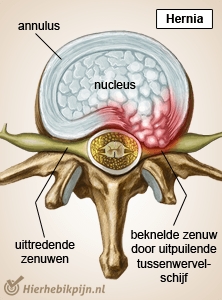 afbeelding_alt_wervelkolom-wervel-tussenwervelschijf-hernia-zenuwen