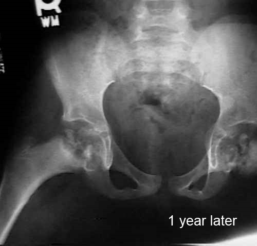 hip Legg-Calvé-Perthes age 7