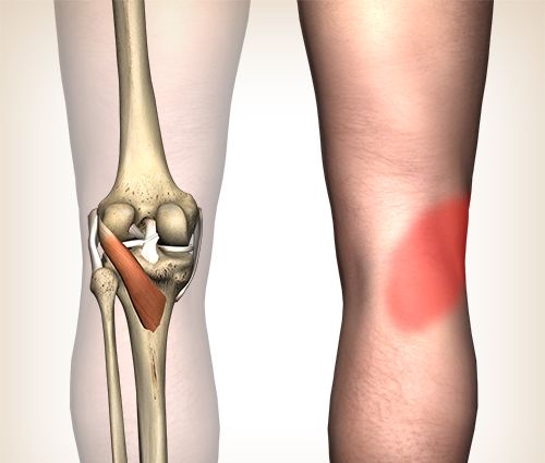 Online exercise program Jumper's knee