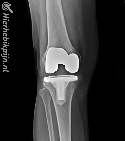 Knie prothese rontgenfoto hele knieprothese kunstknie nieuwe knie vooraanzicht